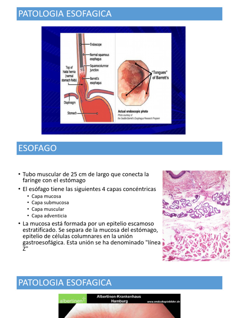 PATOLOGIA ESOFAGICA A | PDF | La enfermedad por reflujo gastroesofágico ...