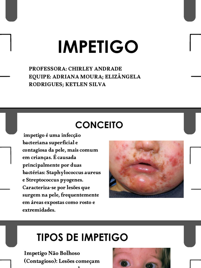 Impetigo: Causas, Sintomas e Tratamento | PDF | Doenças e distúrbios ...