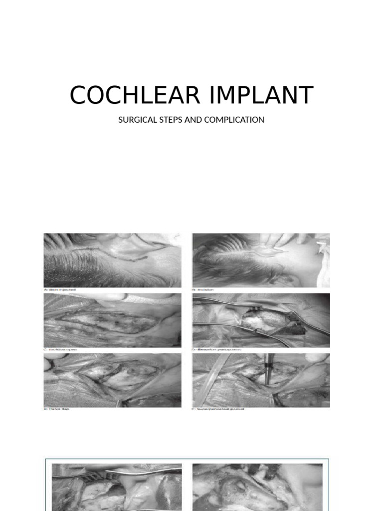 Cochlear Implant | PDF