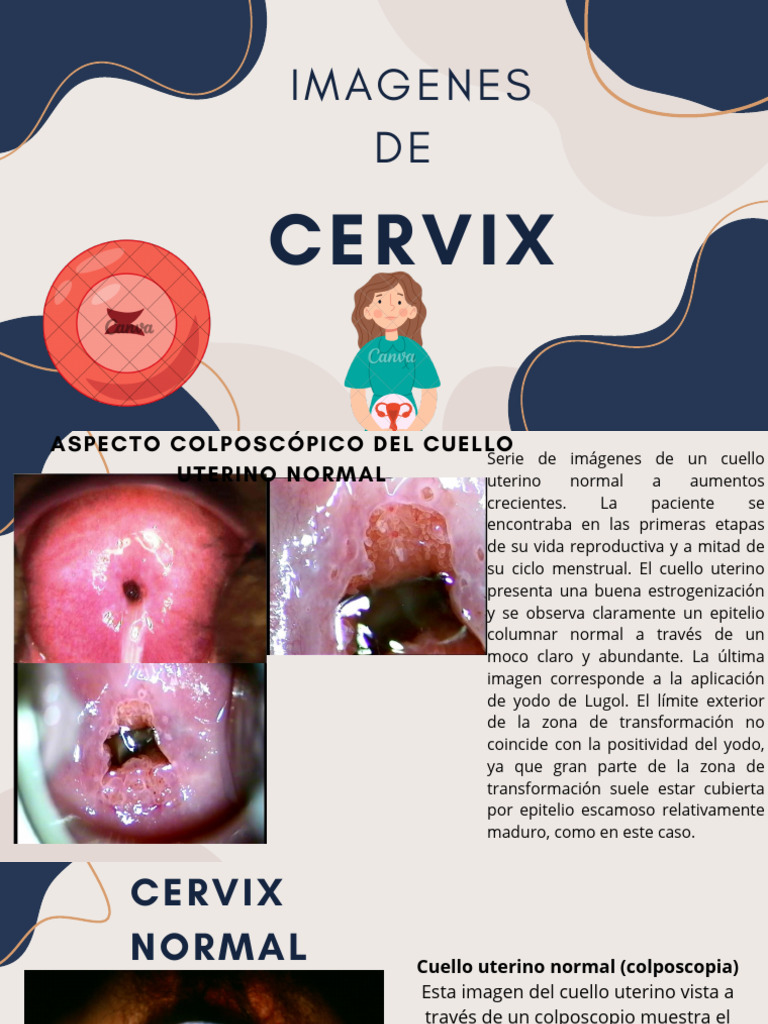 Colposcopia del Cuello Uterino Normal | PDF | Morfología (biología ...