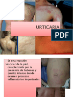 Urticaria