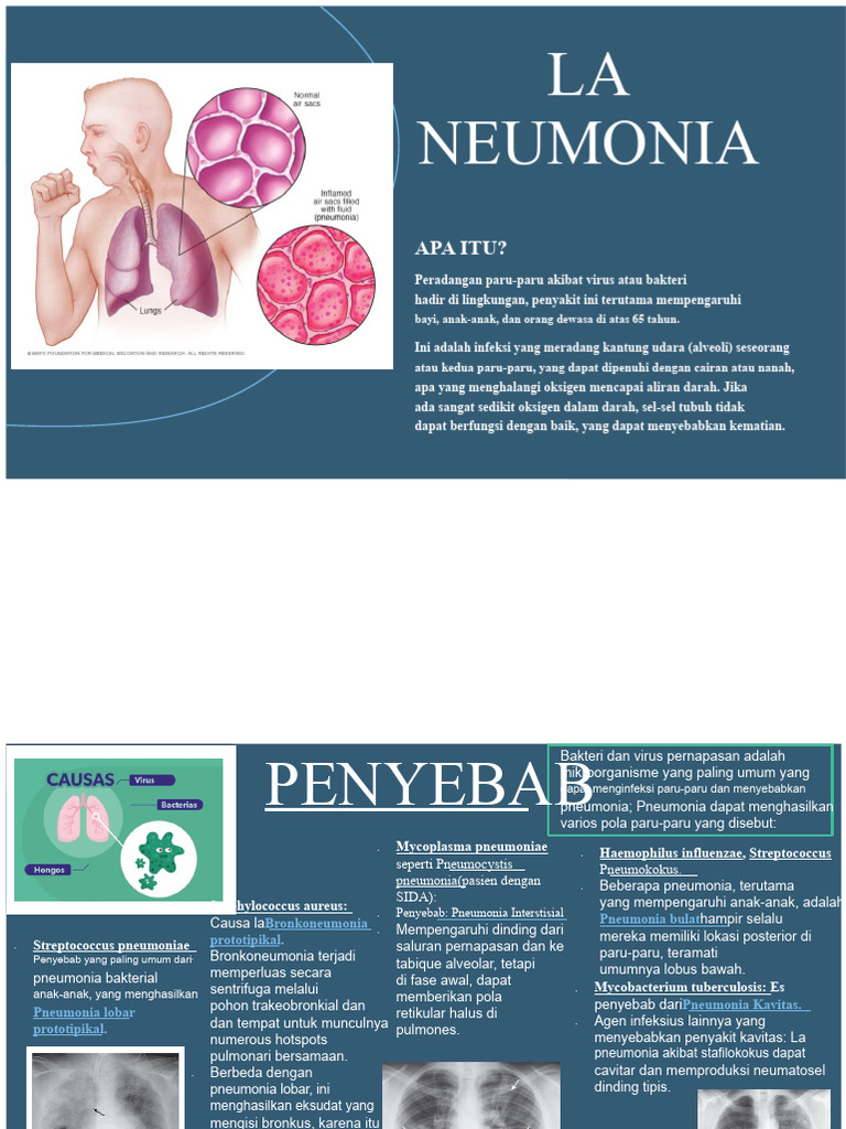 Pneumonia - S.O | PDF