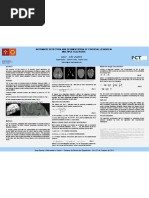 AUTOMATIC DETECTION AND SEGMENTATION OF CORTICAL LESIONS IN  MULTIPLE SCLEROSIS