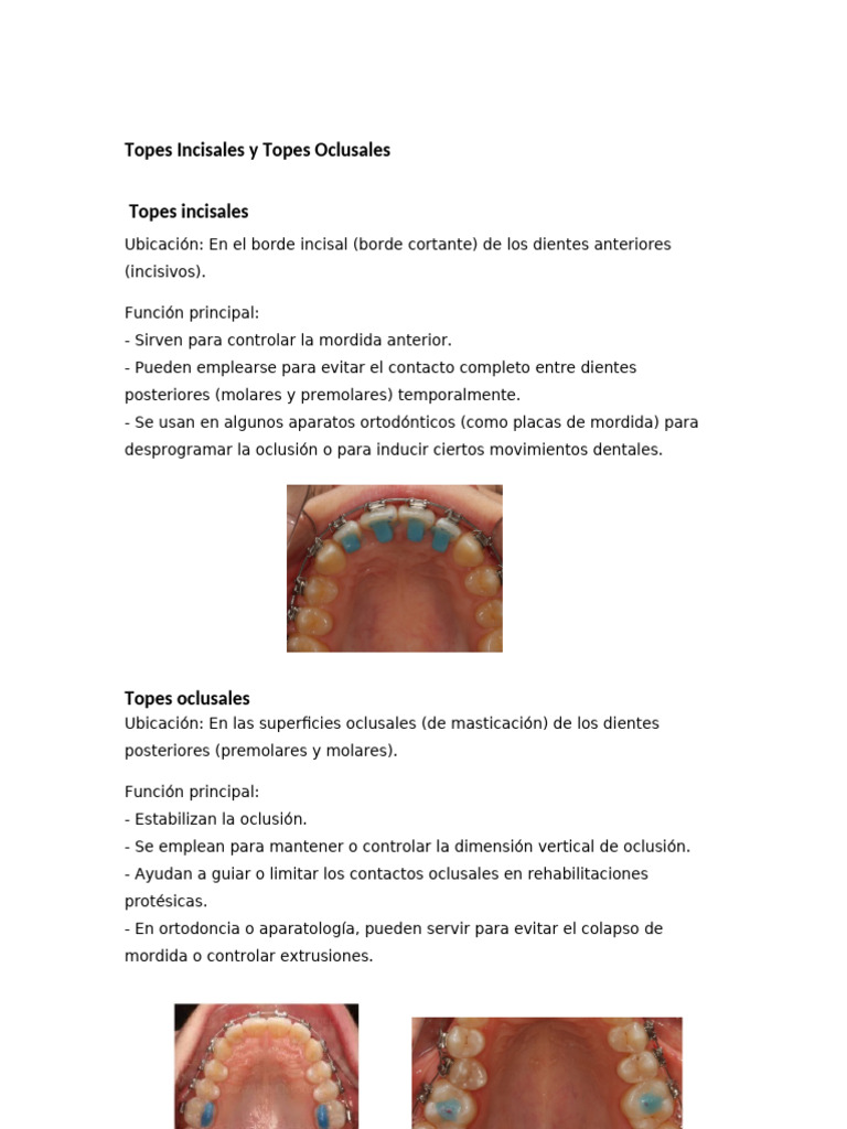 Topes Incisales y Oclusales en Ortodoncia | PDF