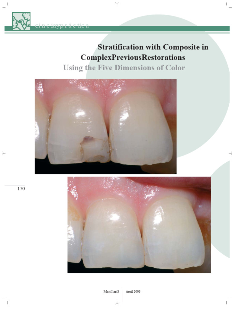 Stratification With Composite in Complex Anterior Restorations Using ...