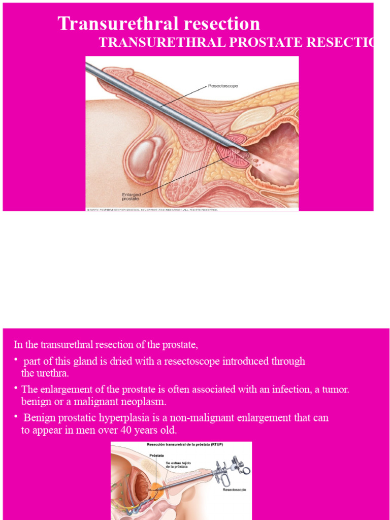 Transurethral Prostate Resection Guide | PDF | Prostate | Surgery