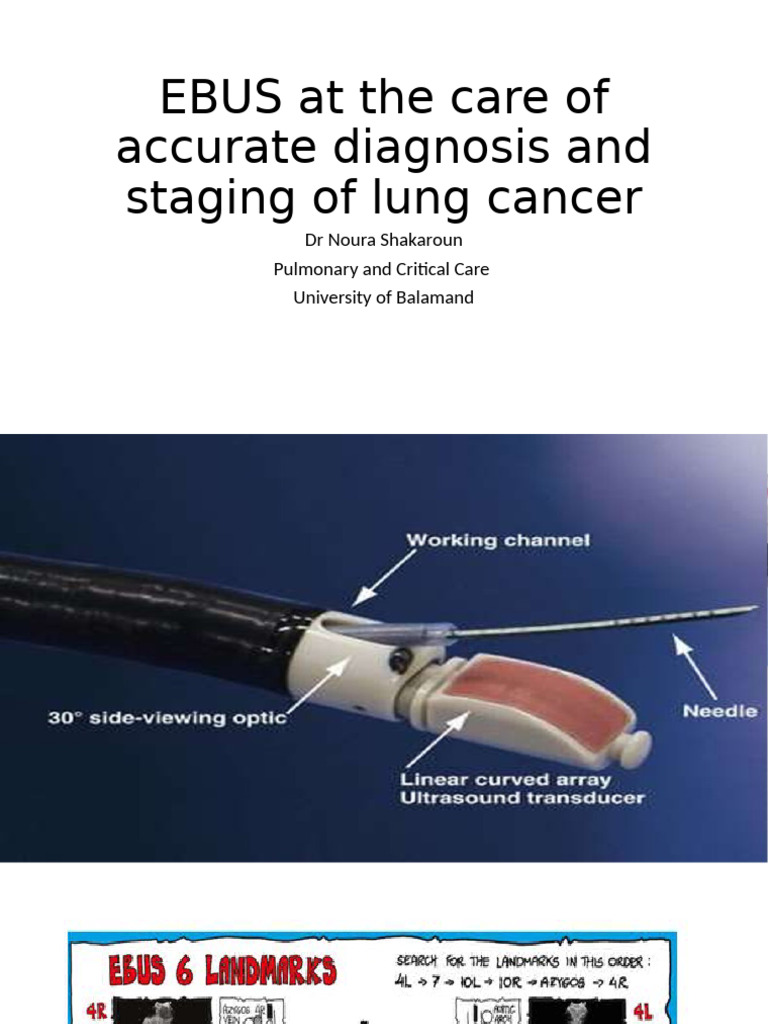 EBUS for Lung Cancer Diagnosis and Staging | PDF | Lung Cancer ...