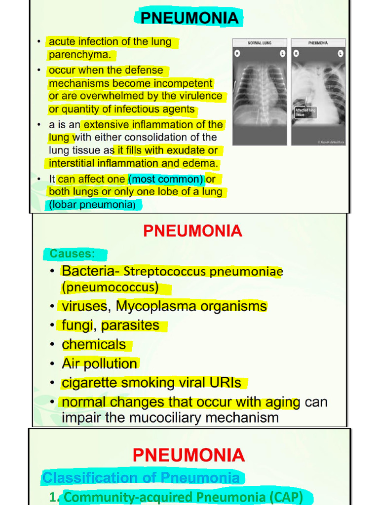 Pneumonia | PDF