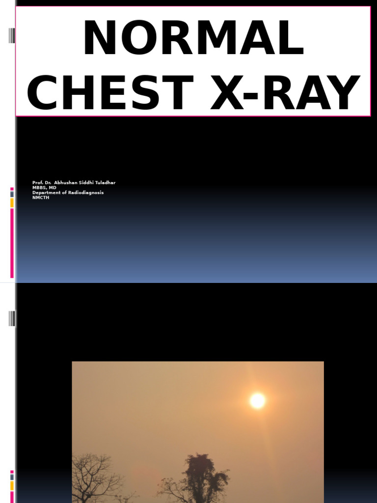 Understanding Normal Chest X-Ray Analysis | PDF | Lung | Heart Valve