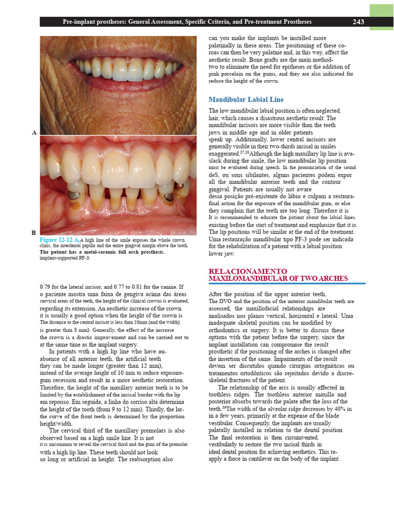 Pre-implant Prostheses Assessment Guide | PDF | Dental Implant | Prosthesis