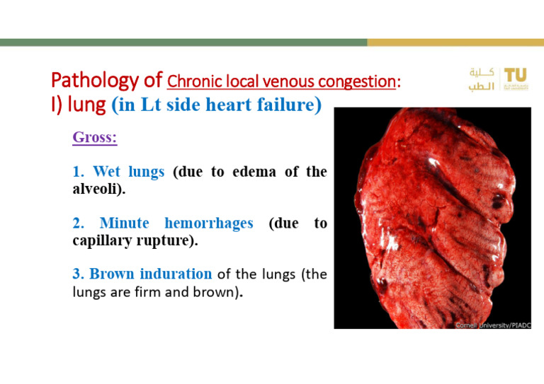 Pathology of Lung Congestion in Heart Failure | PDF