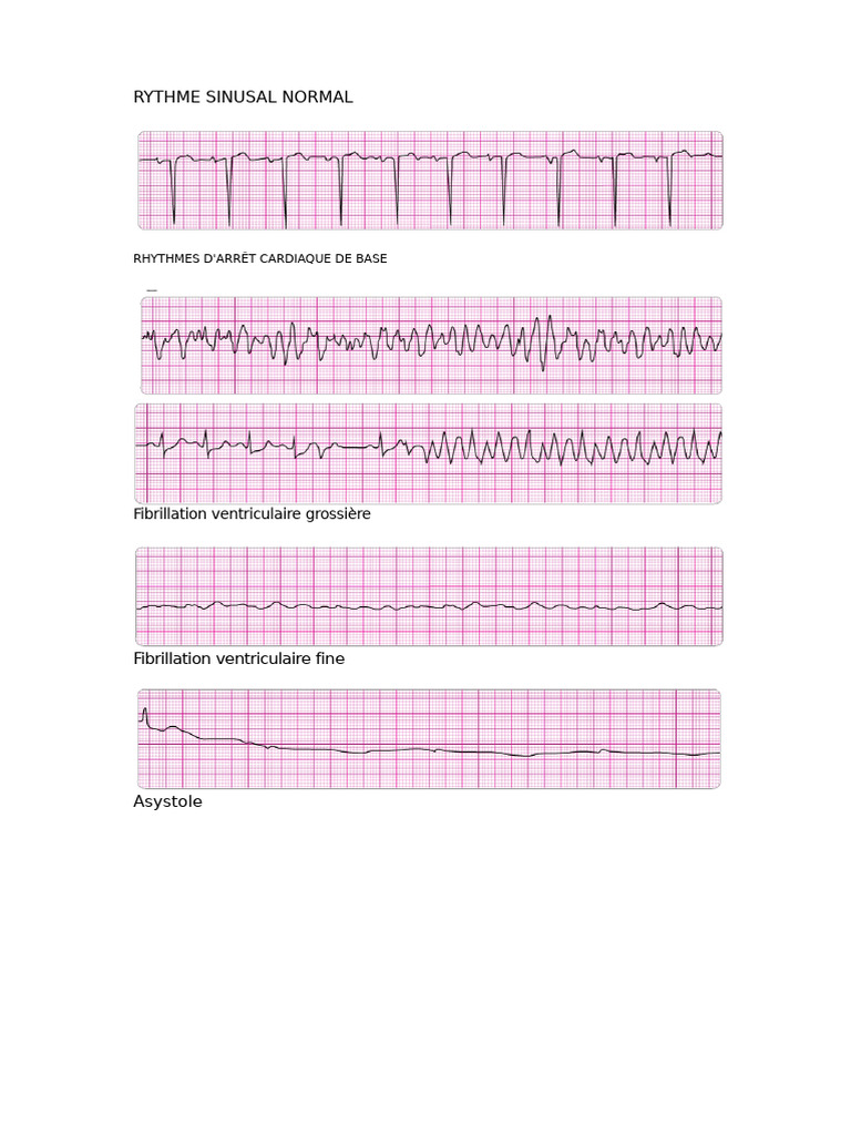 Rythmes Cardiaques et Interventions ACLS | PDF