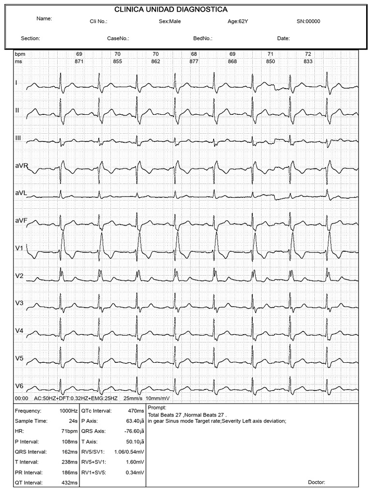 ECG Report for Male Patient 62Y | PDF