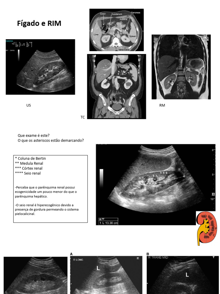 Ecogenicidade Hepática e Renal em Exames | PDF | Rim | Ultrassom médico