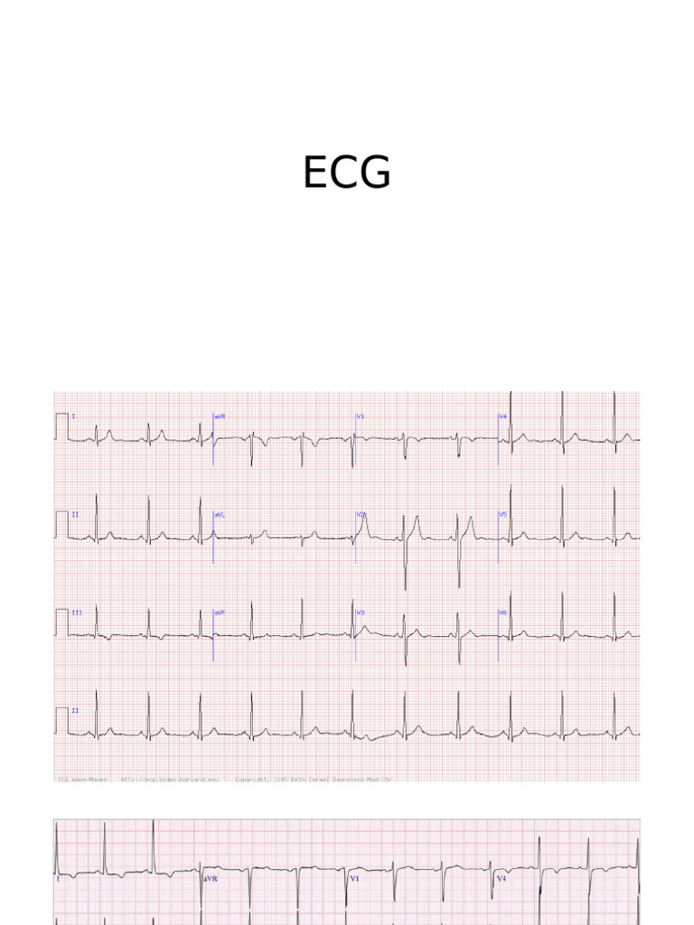 ECG | PDF