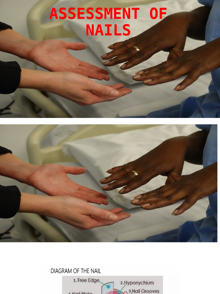 Nail Assessment Techniques and Findings | PDF