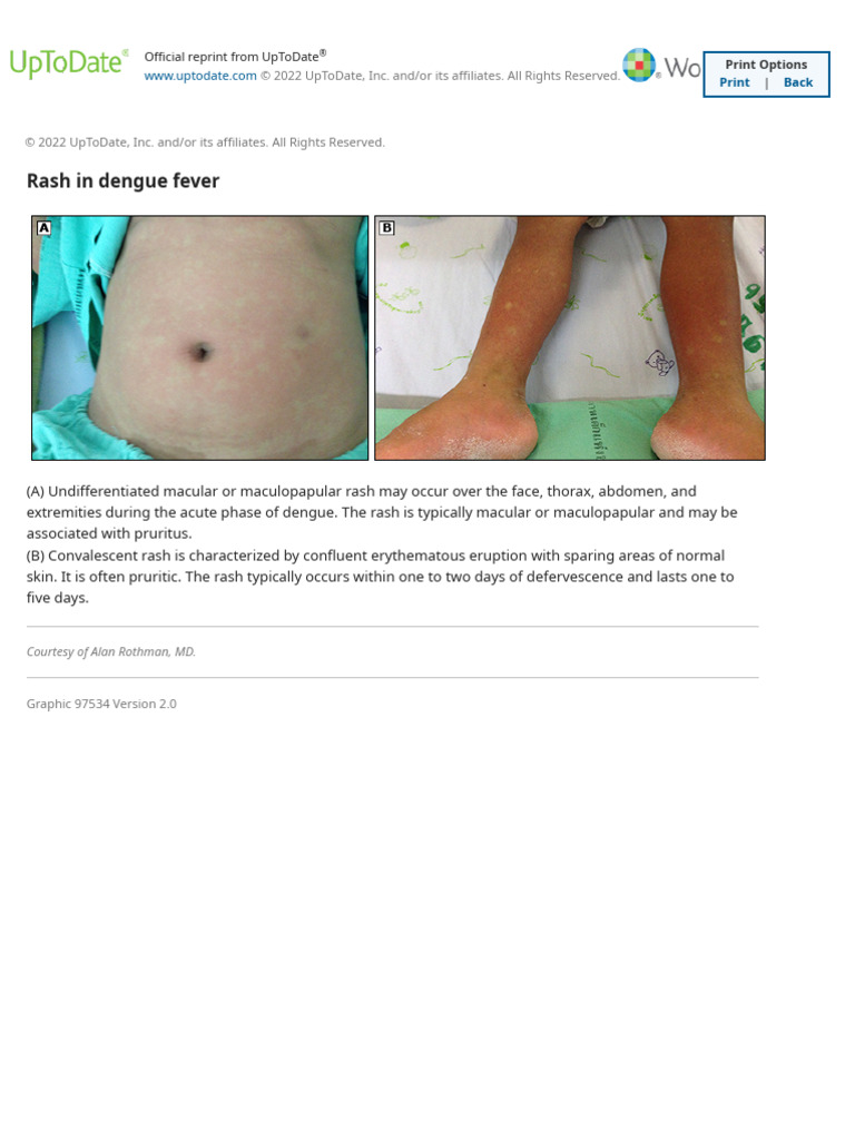 Dengue Fever Rash Overview | PDF
