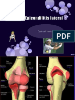 Epicondilitis Lateral