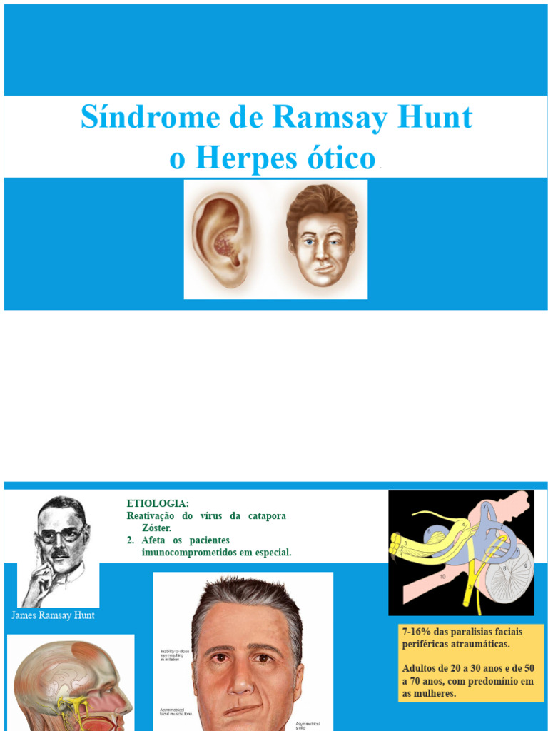 Síndrome de Ramsay Hunt: Causas e Sintomas | PDF | Especialidades ...