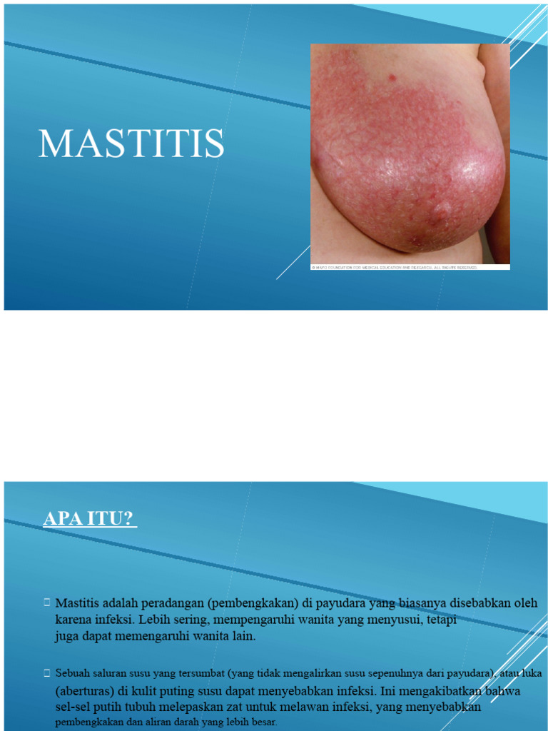 Panduan Lengkap Mastitis pada Ibu Menyusui | PDF