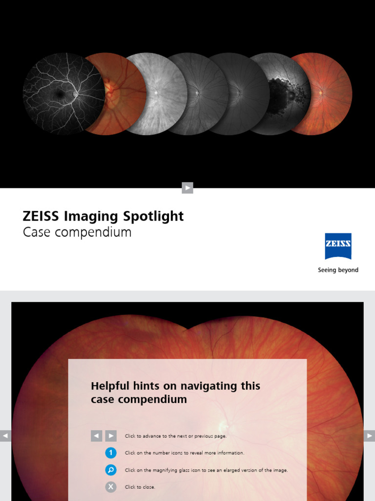 ZEISS Ultra-Widefield Retinal Imaging Guide | PDF | Retina | Angiography