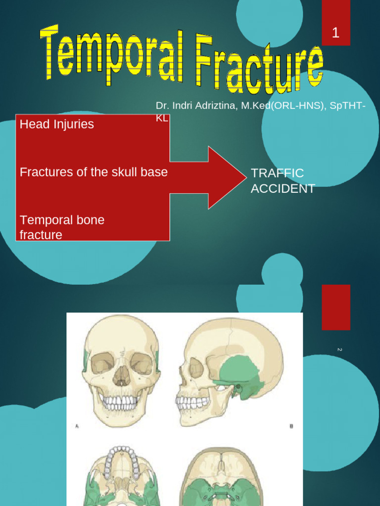 Temporal Bone Fractures Overview | PDF | Skull | Human Anatomy