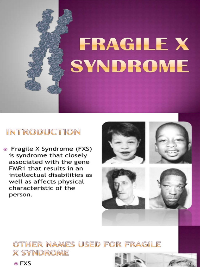 Fragile X Syndrome | PDF