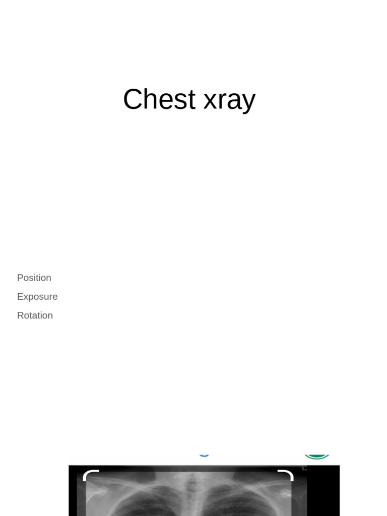 Chest X-Ray Analysis and Findings | PDF