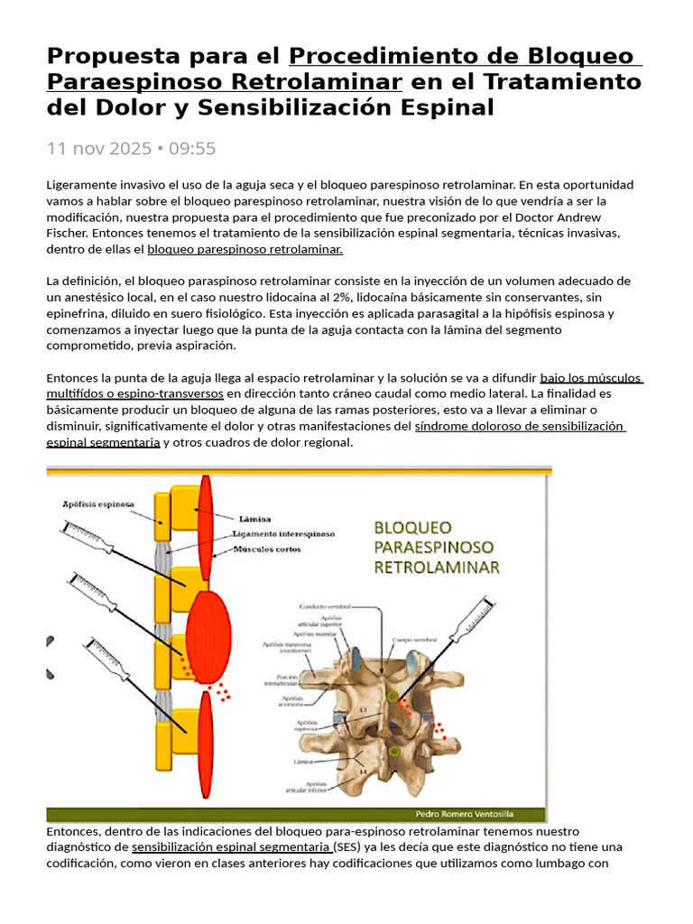 Propuesta de Bloqueo Parespinoso Retrolaminar | PDF | Inyección (medicina)
