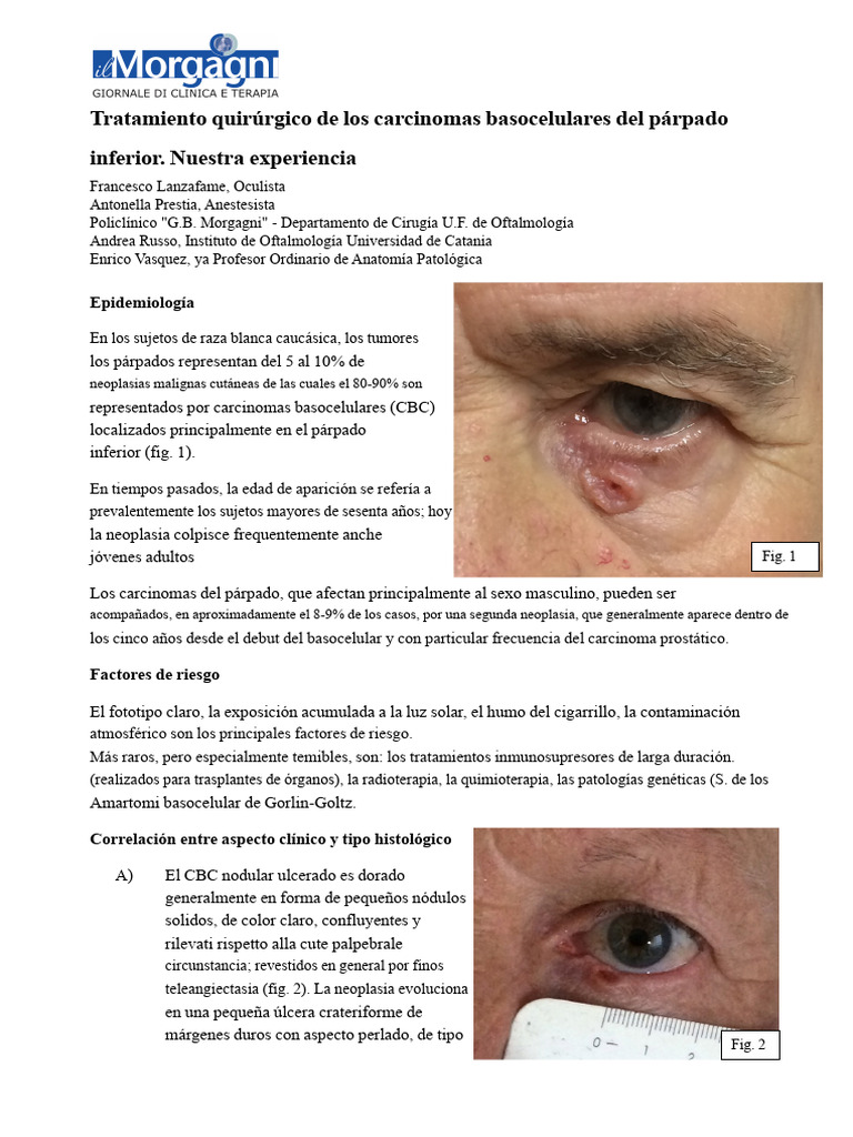 tratamiento-quir-rgico-de-los-carcinomas-basocelulares-del-p-rpado