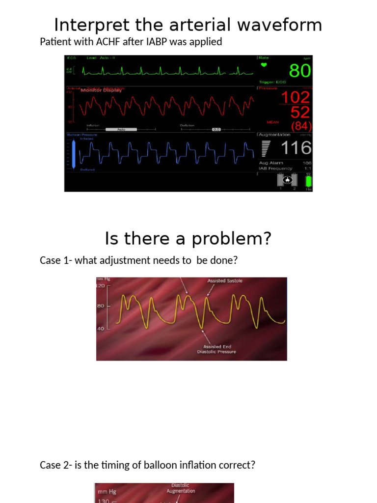 Arterial Waveforms, Capnogtraphy, ICP, TEG, CVP, Esophageal Pressure ...