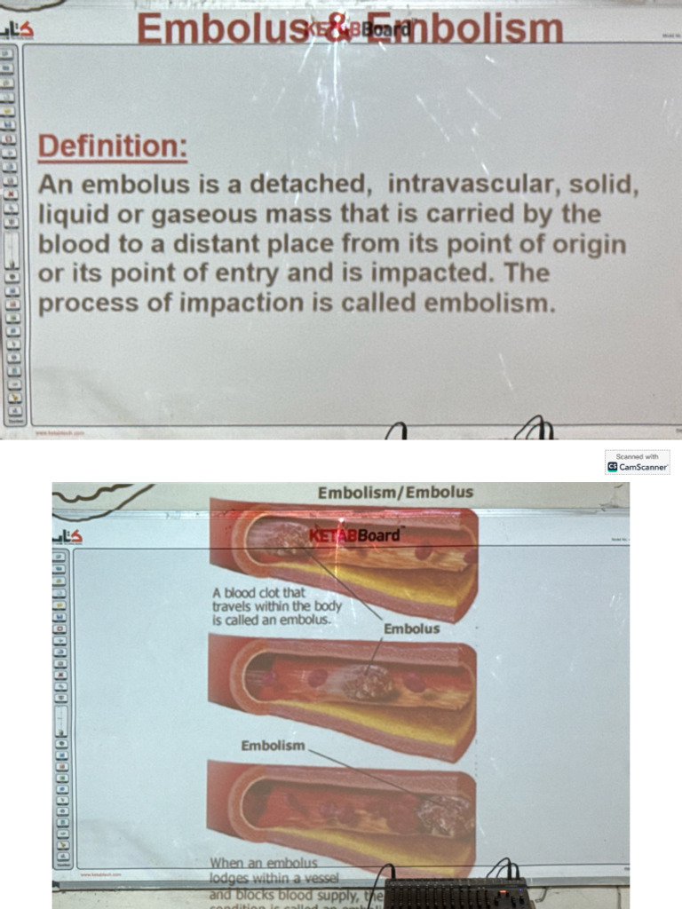 Embolus - Embolism | PDF
