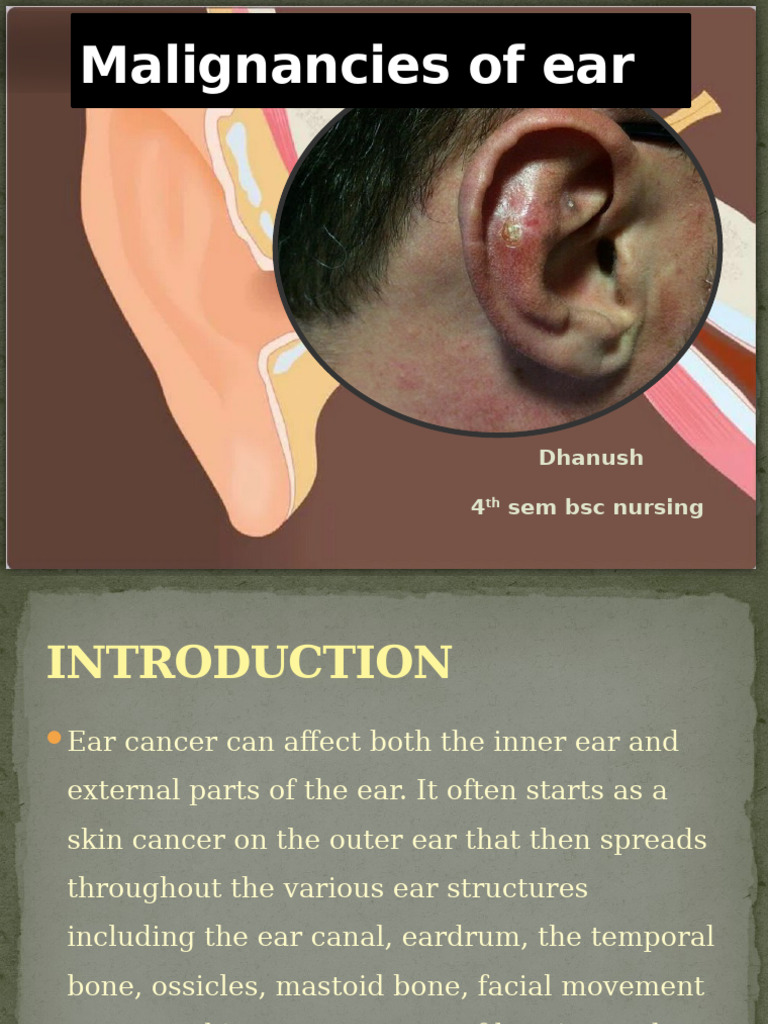 Ear Cancer: Types, Symptoms, and Management | PDF | Ear | Cancer