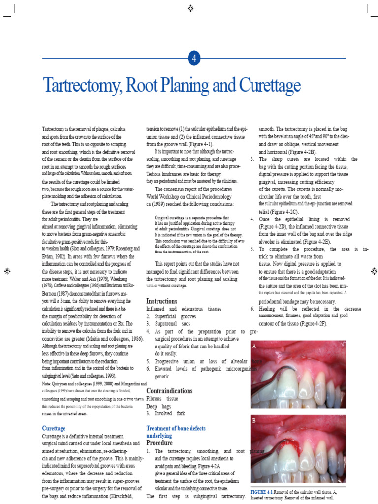 Tartrectomy and Root Planing Overview | PDF | Periodontology | Medical ...