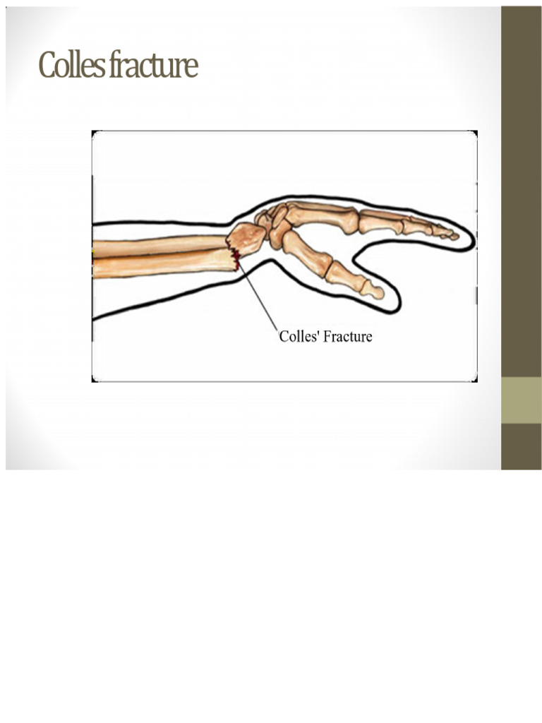 Colles Fracture: Symptoms and Treatment | PDF | Hand | Anatomical Terms ...