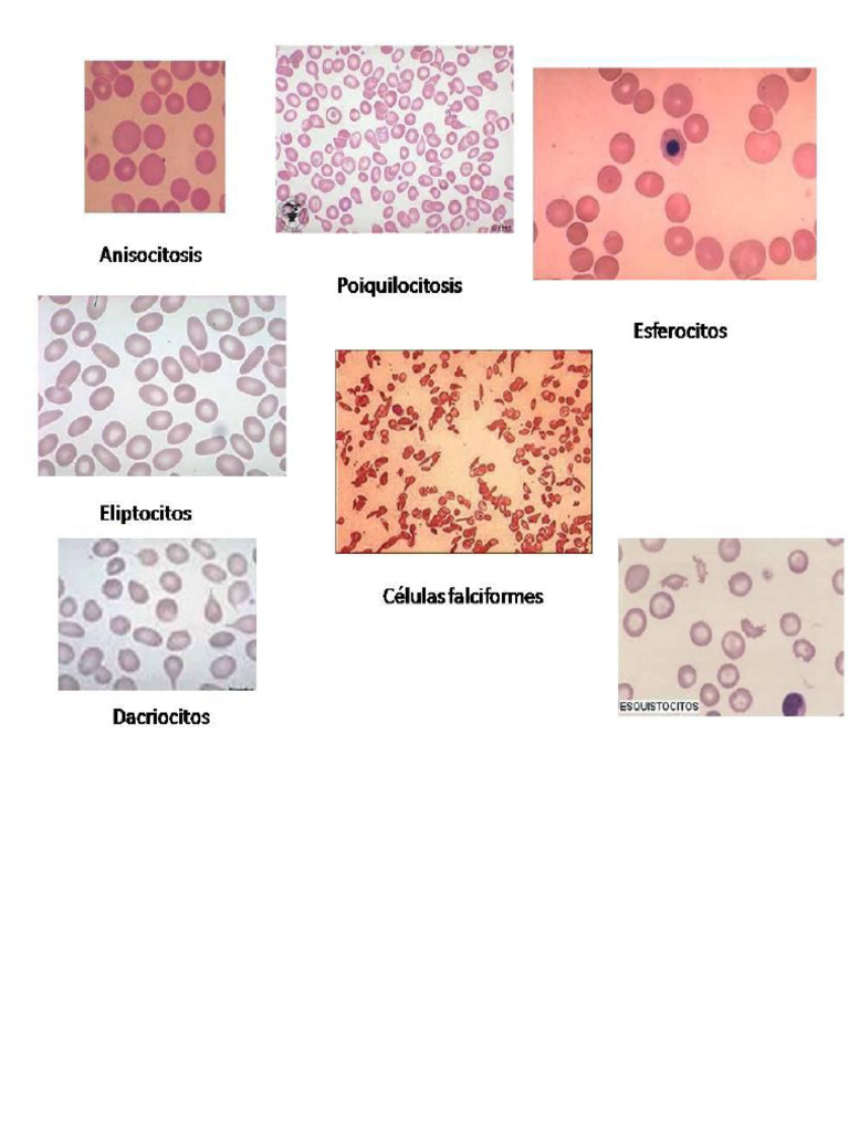Erythrocyte Abnormalities Overview | PDF | Anemia | Red Blood Cell