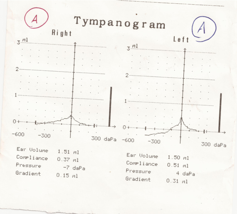 Timpanometría | PDF