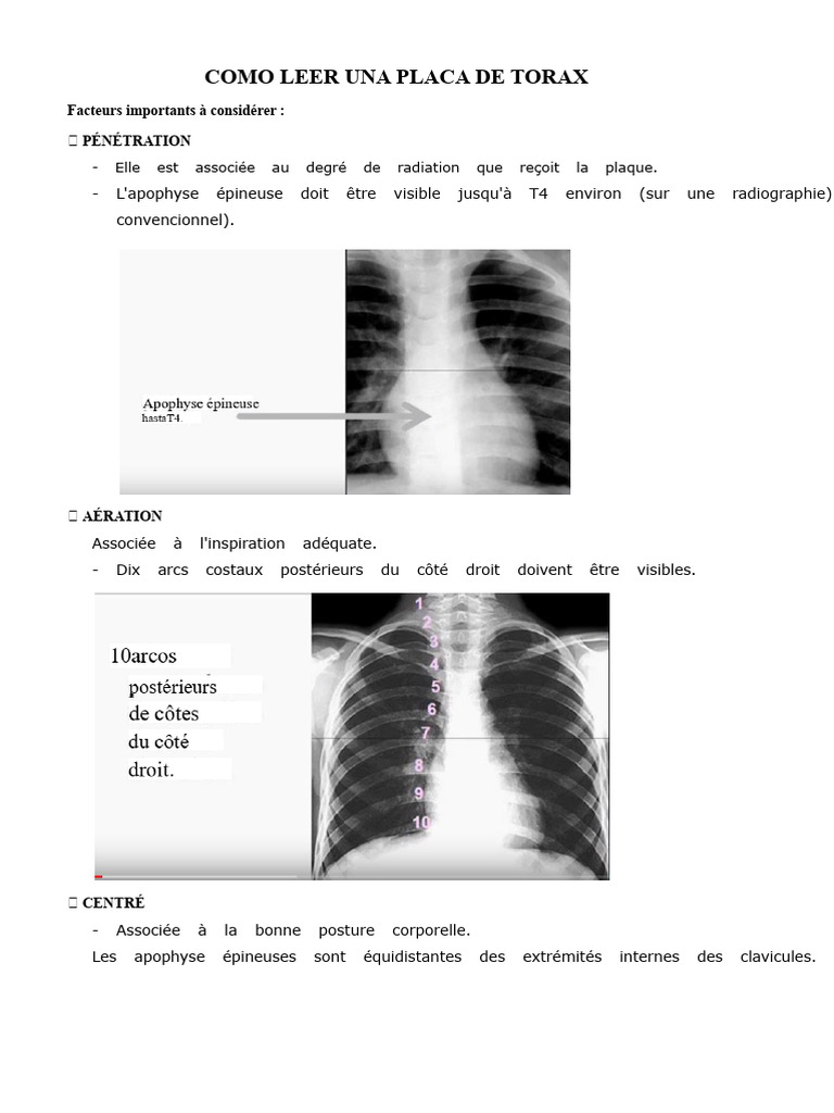 Guide de lecture d'une radiographie thoracique | PDF | Radiographie ...