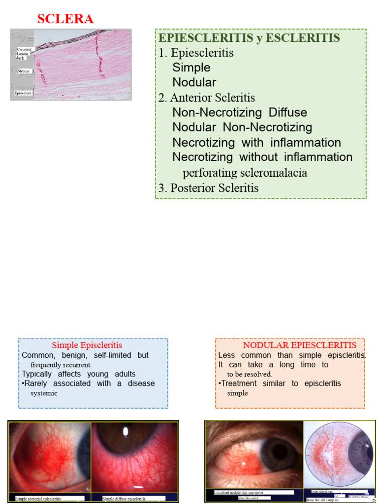 Epiescleritis and Scleritis | PDF | Diseases And Disorders | Human Eye