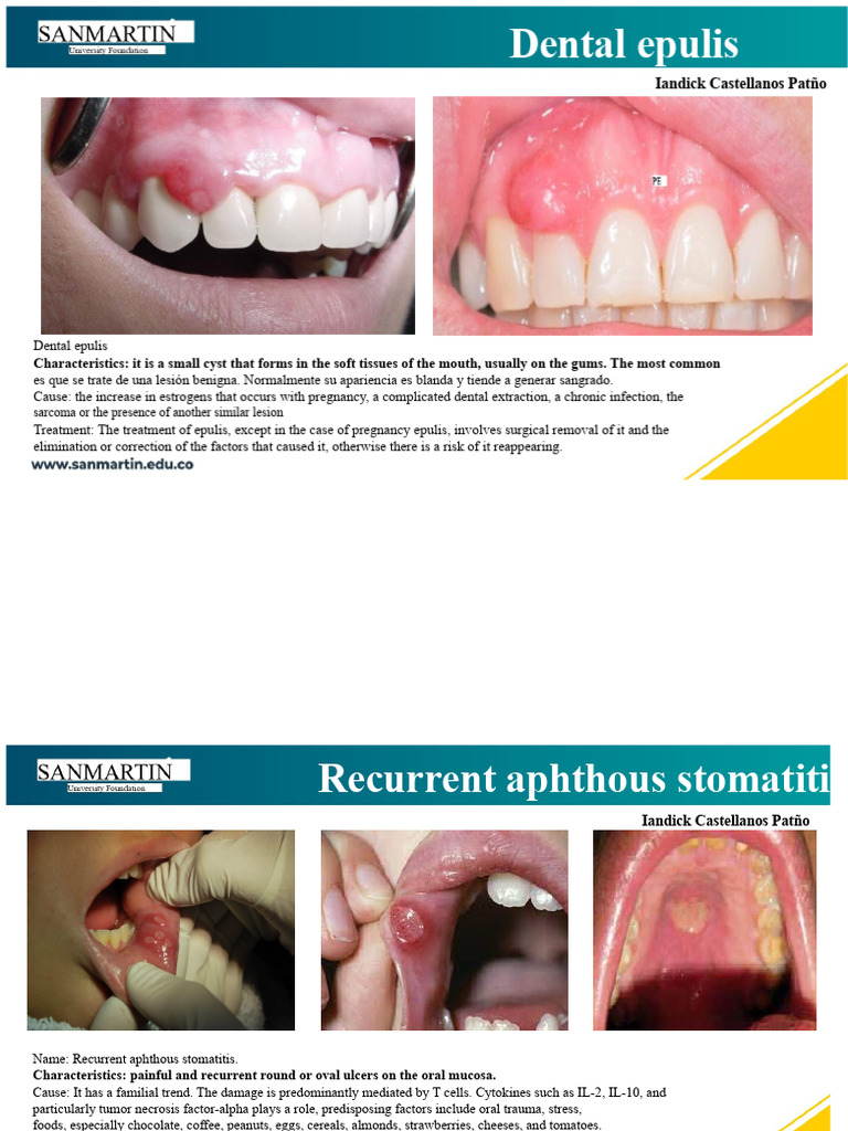 Understanding Dental Epulis and Stomatitis | PDF