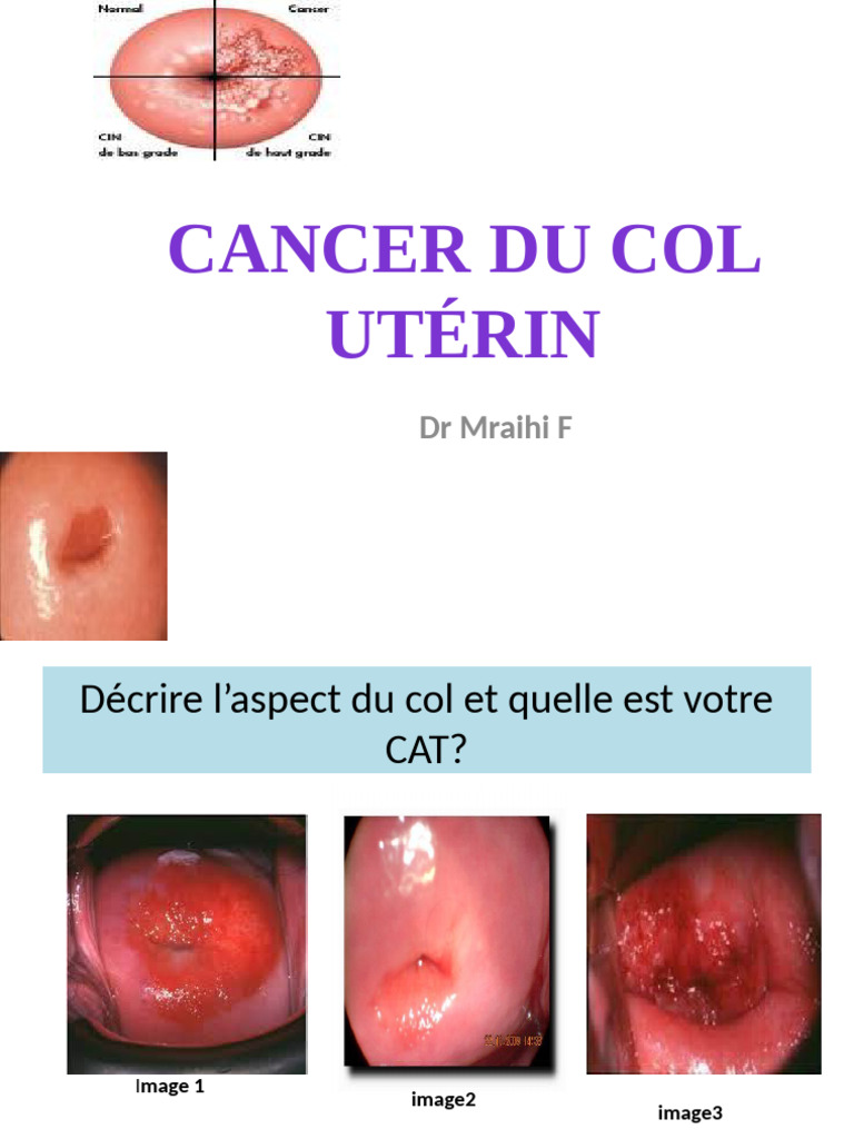 Prévention du cancer du col utérin | PDF | Cancer du col utérin | Cancer