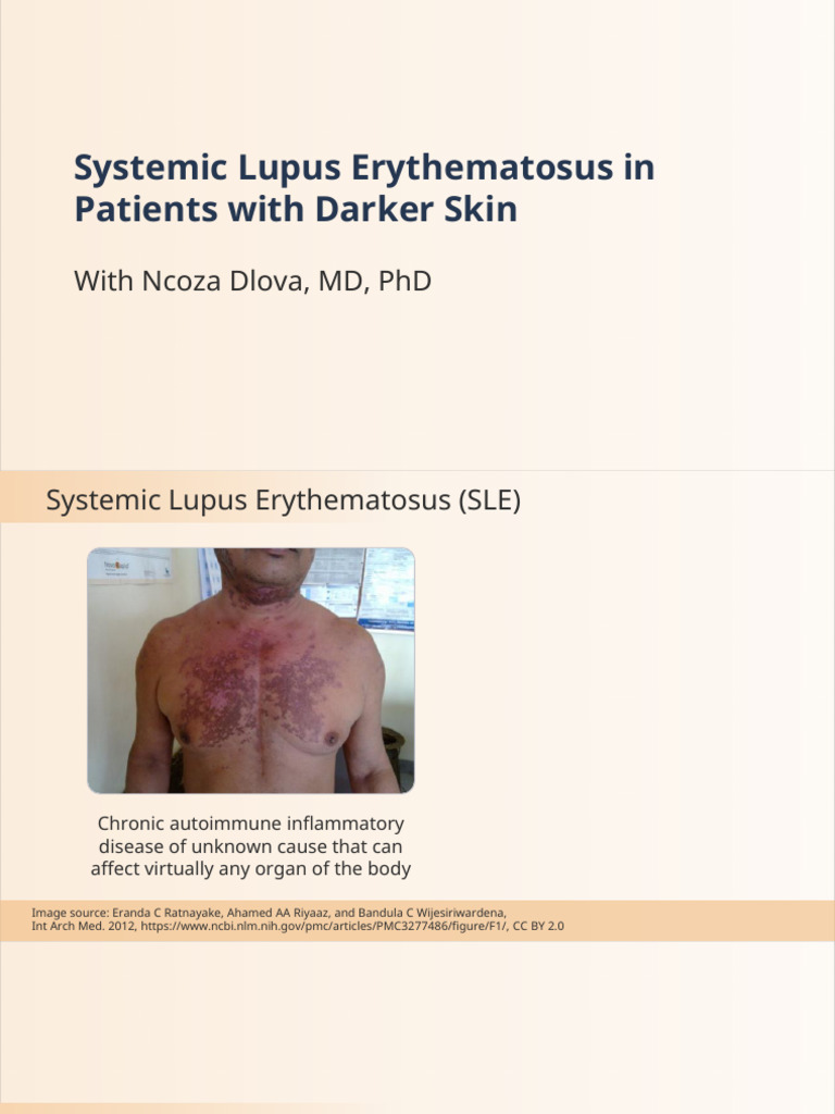 Slides Systemic Lupus Erythematosus | PDF | Autoimmune Disease | Human ...
