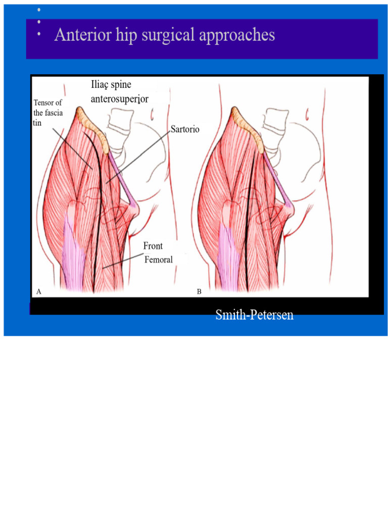 Surgical Approaches To The Hip | PDF