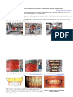Enfilado dentario de prótesis de completa con esquema oclusal lingualizado