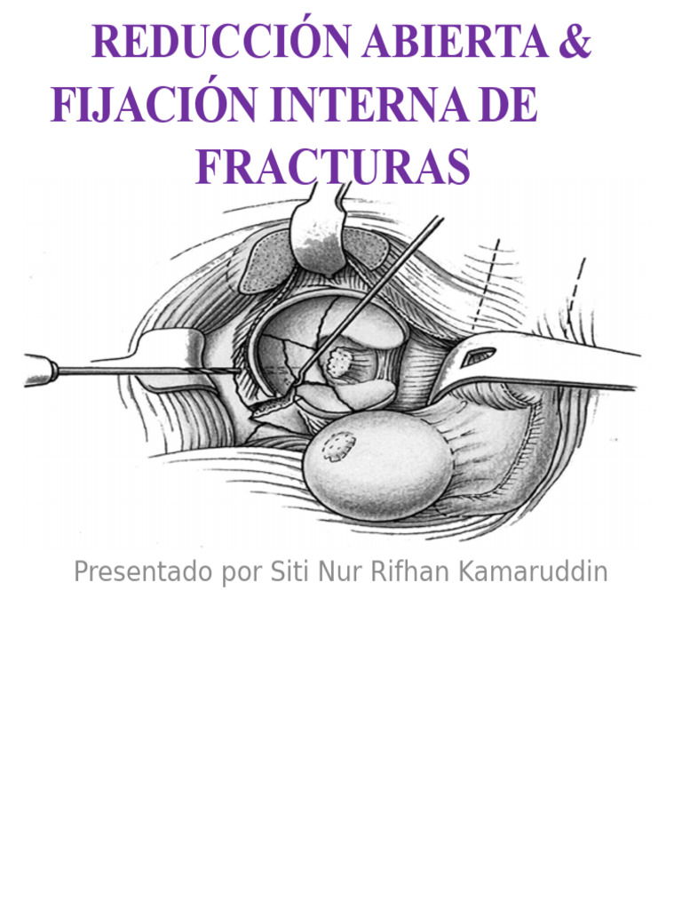 Reducción y Fijación Interna de Fracturas | PDF | Hueso | Cirugía