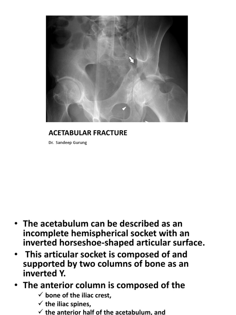 Thesis hip fractures 05 picture