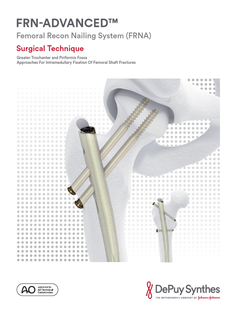Femoral Recon Nailing Surgical Guide | PDF | Screw | Musculoskeletal System