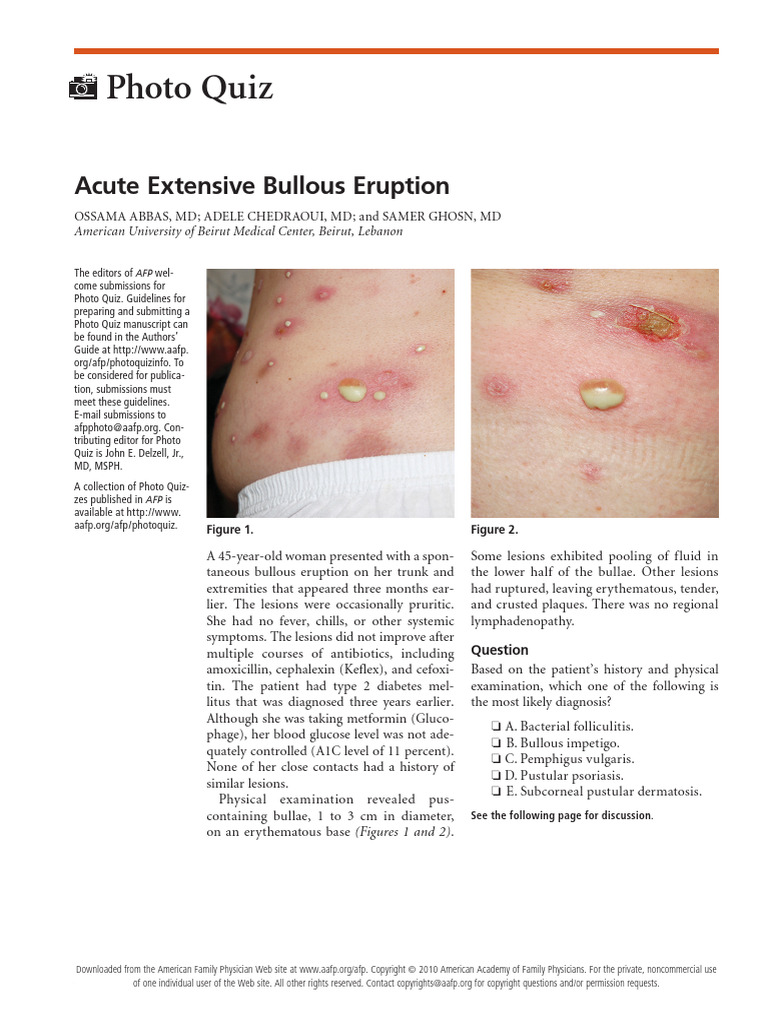 Bullous Impetigo Diagnosis Case Study | PDF | Staphylococcus Aureus ...