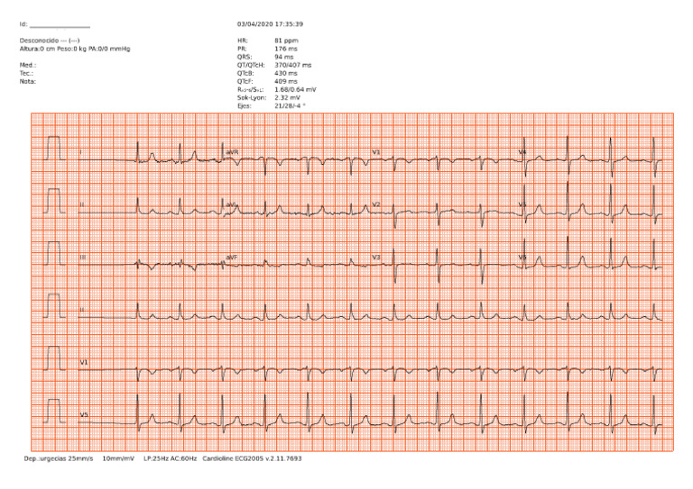 EKG Normal | PDF