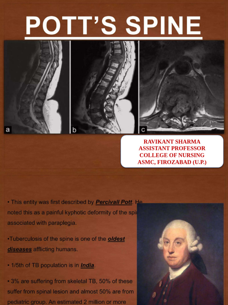 Pott's Spine | PDF